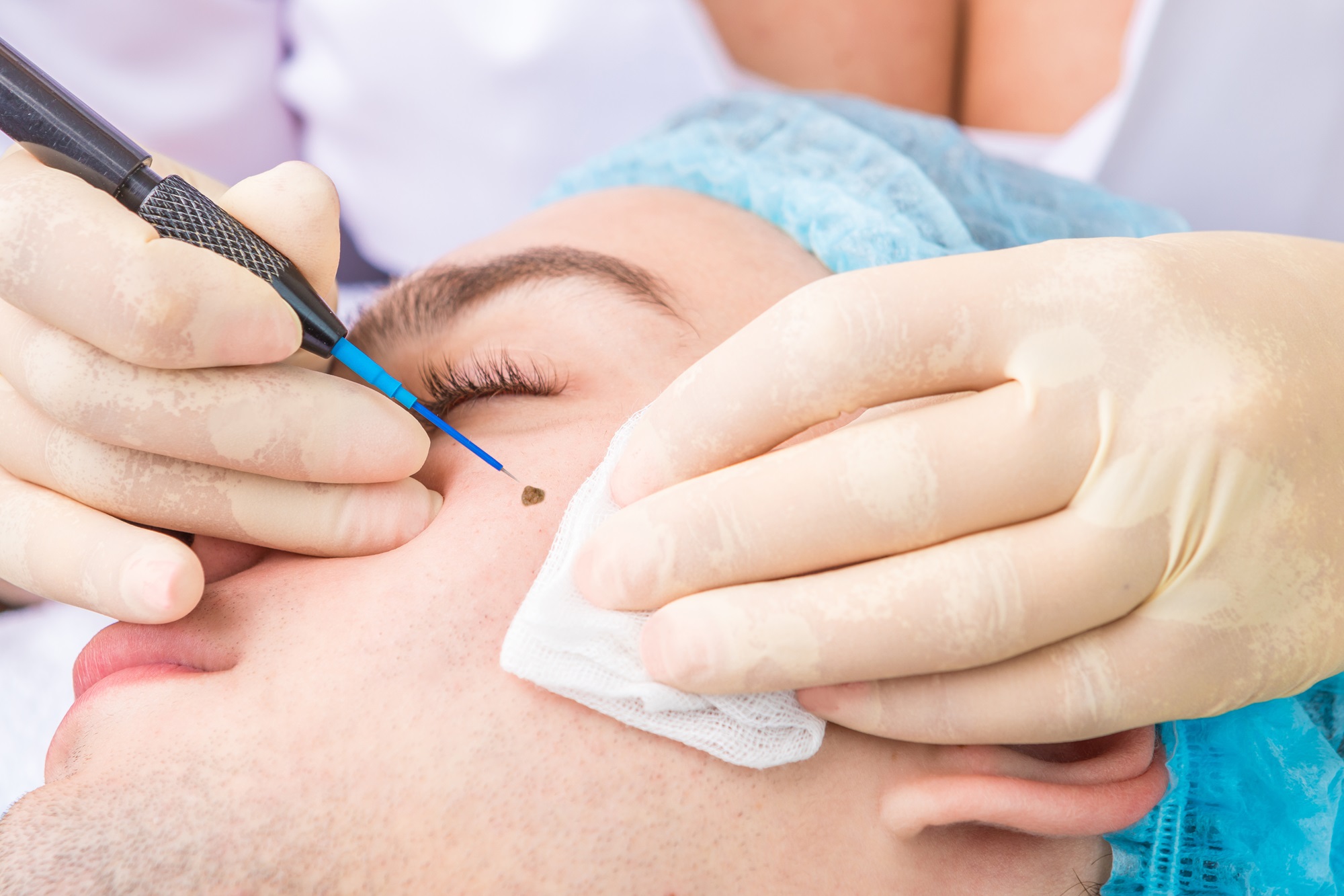 affordable mole removal riverside california