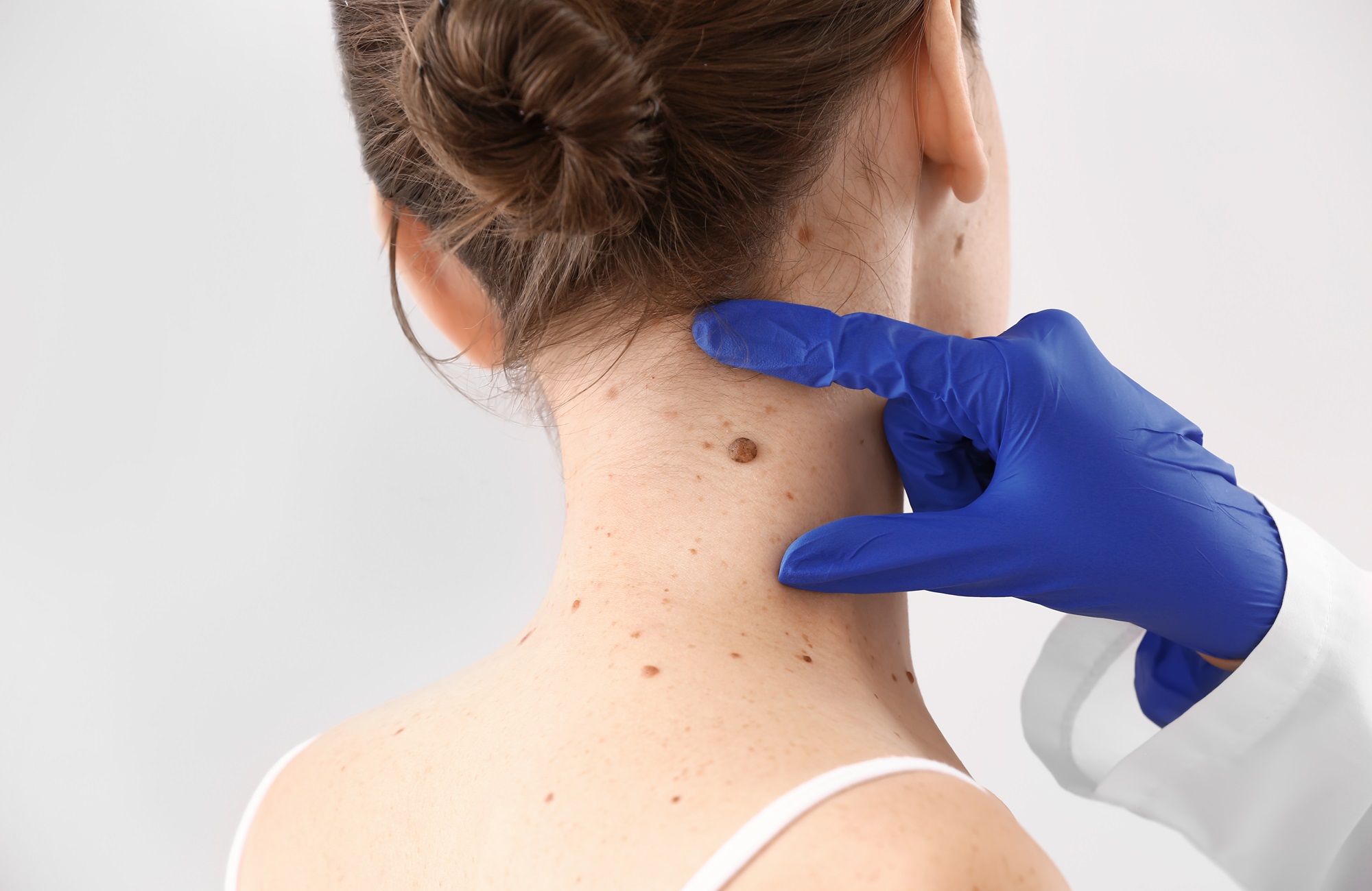 expert mole removal riverside california