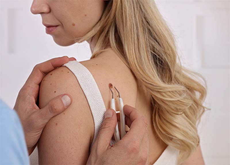 expert mole removal eastvale california