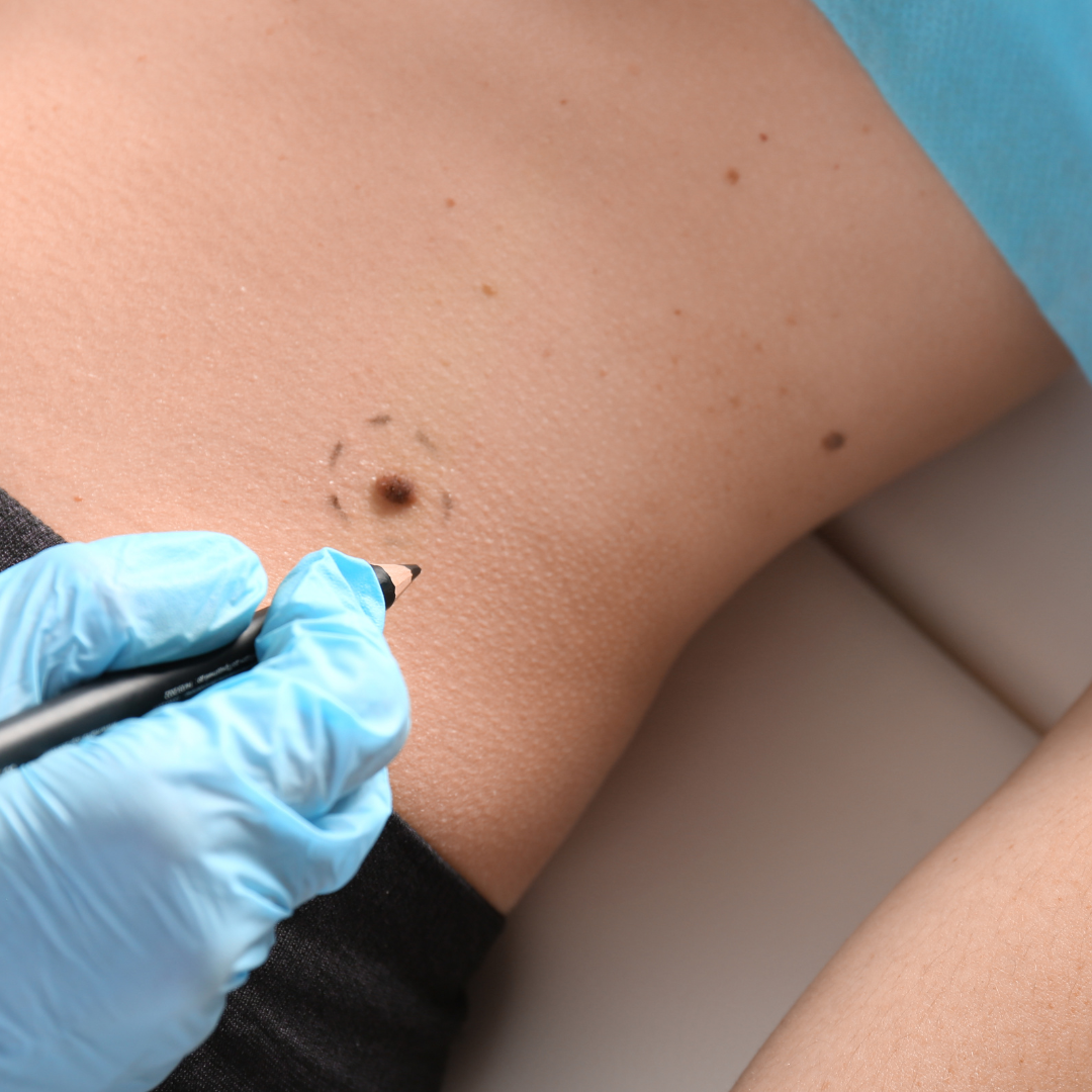 Plasma Pen Mole Removal Temecula