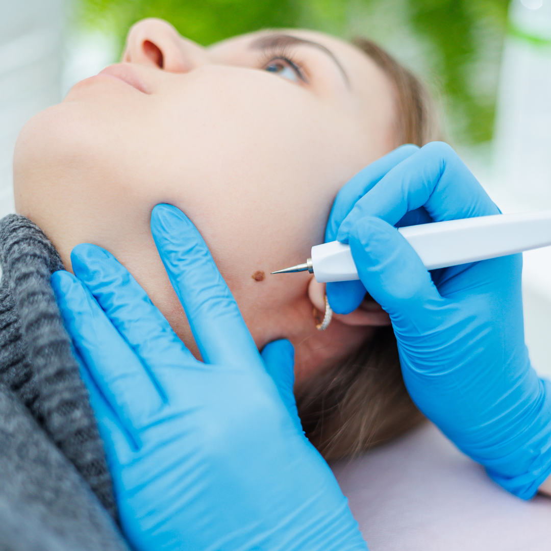 Plasma Pen Mole Removal