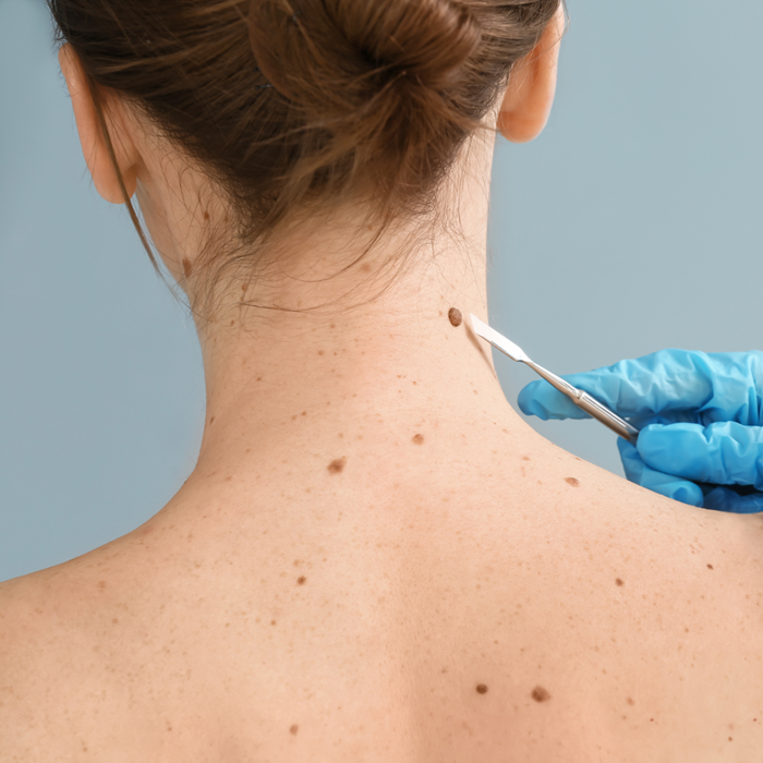affordable mole removal Beaumont California