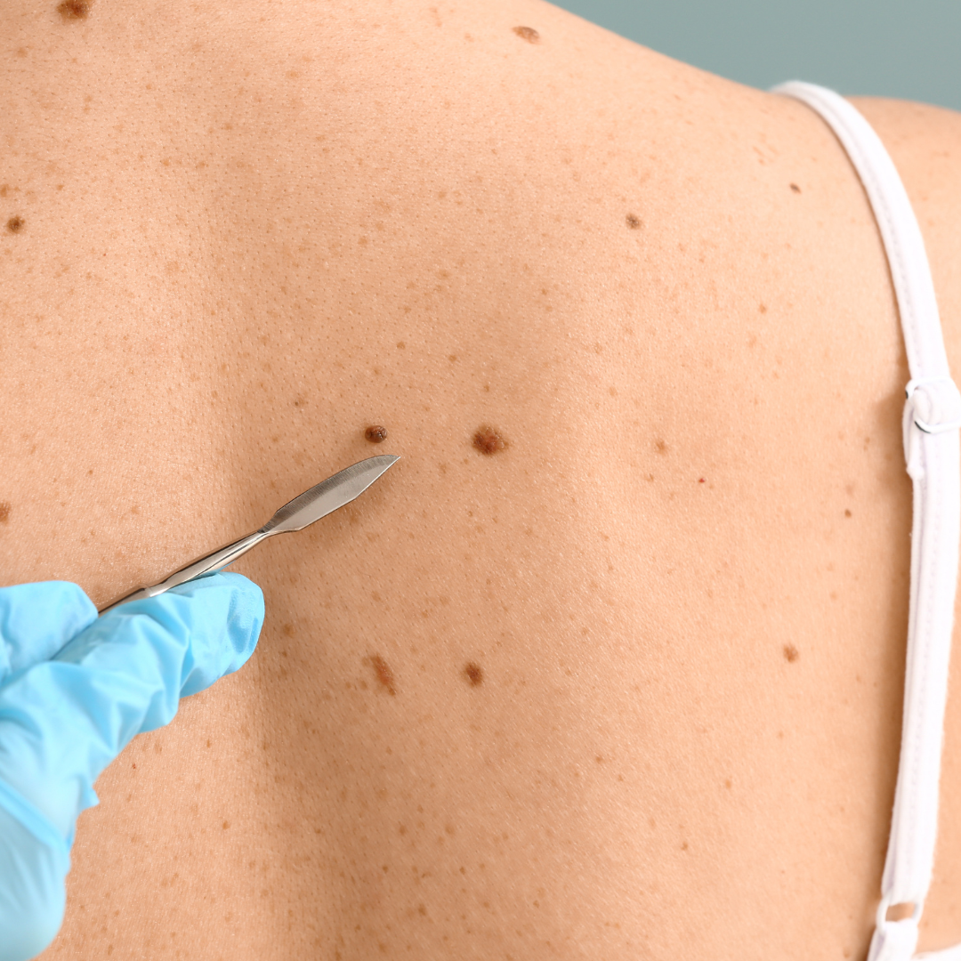 affordable mole removal Wildomar