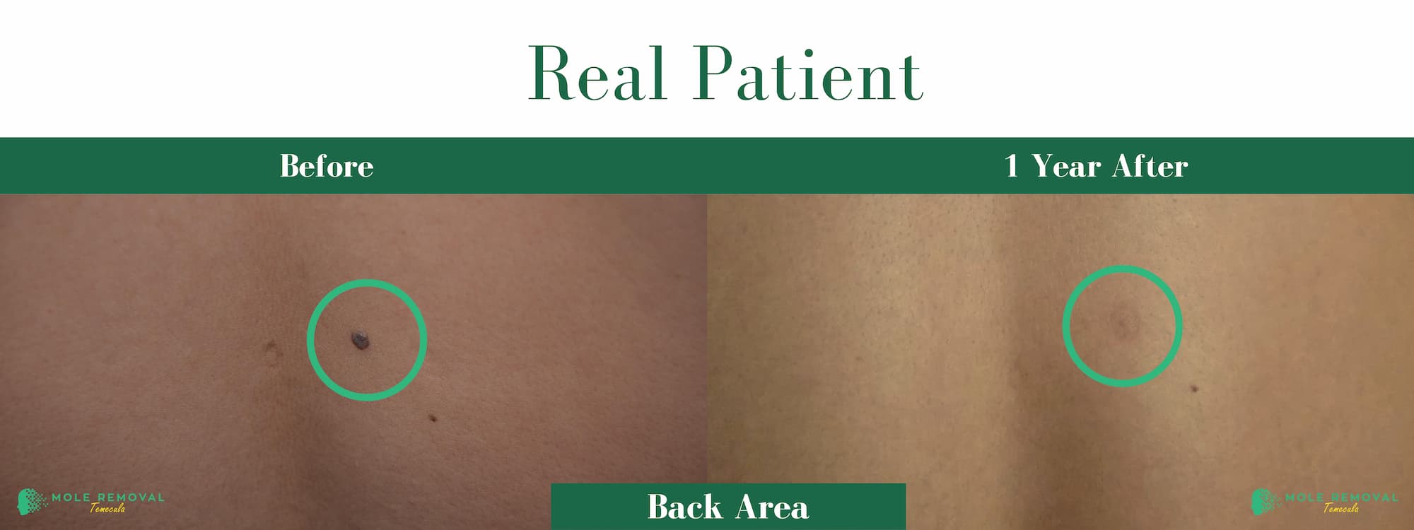 TEM NEW BEFORE_AFTER PIC APRIL 26