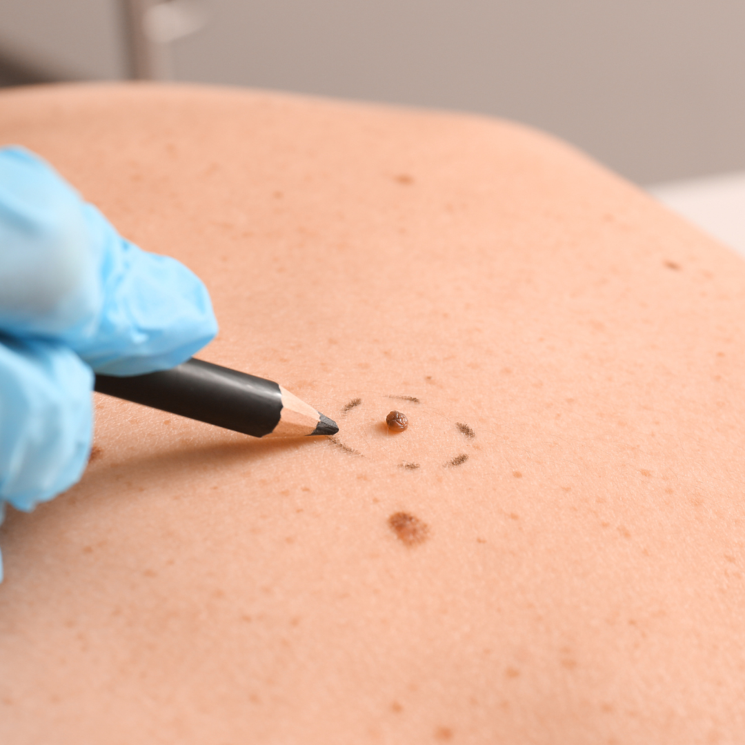 DIY mole removal